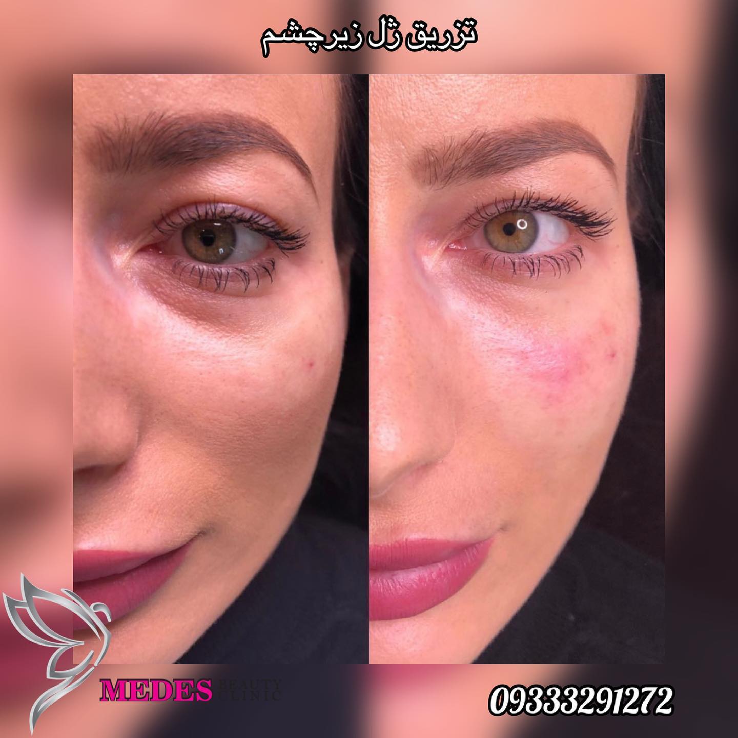 گالری فیلر زیر چشم